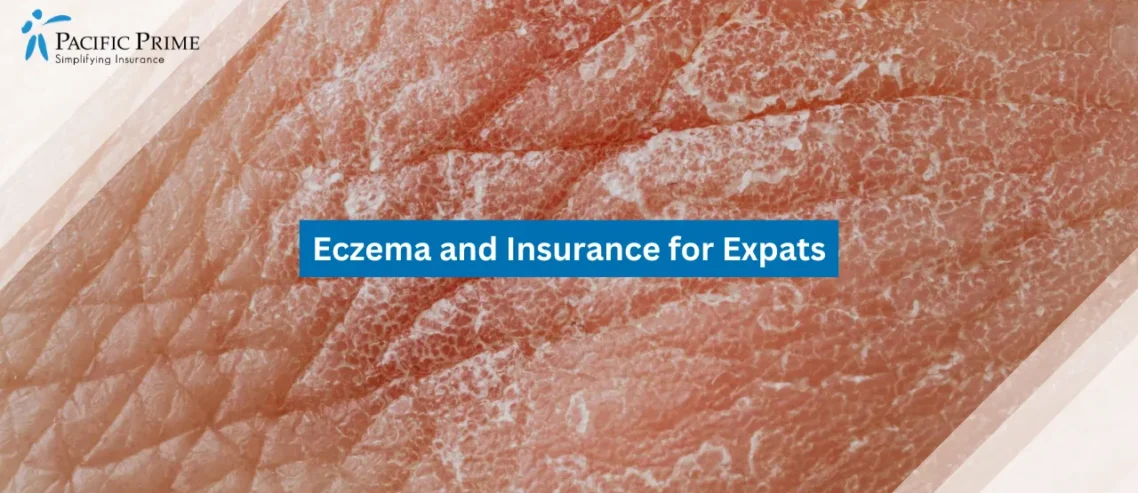 Image of Close-up Of Dry Human Skin With Visible Texture with text overlay of "Eczema and Insurance for Expats"